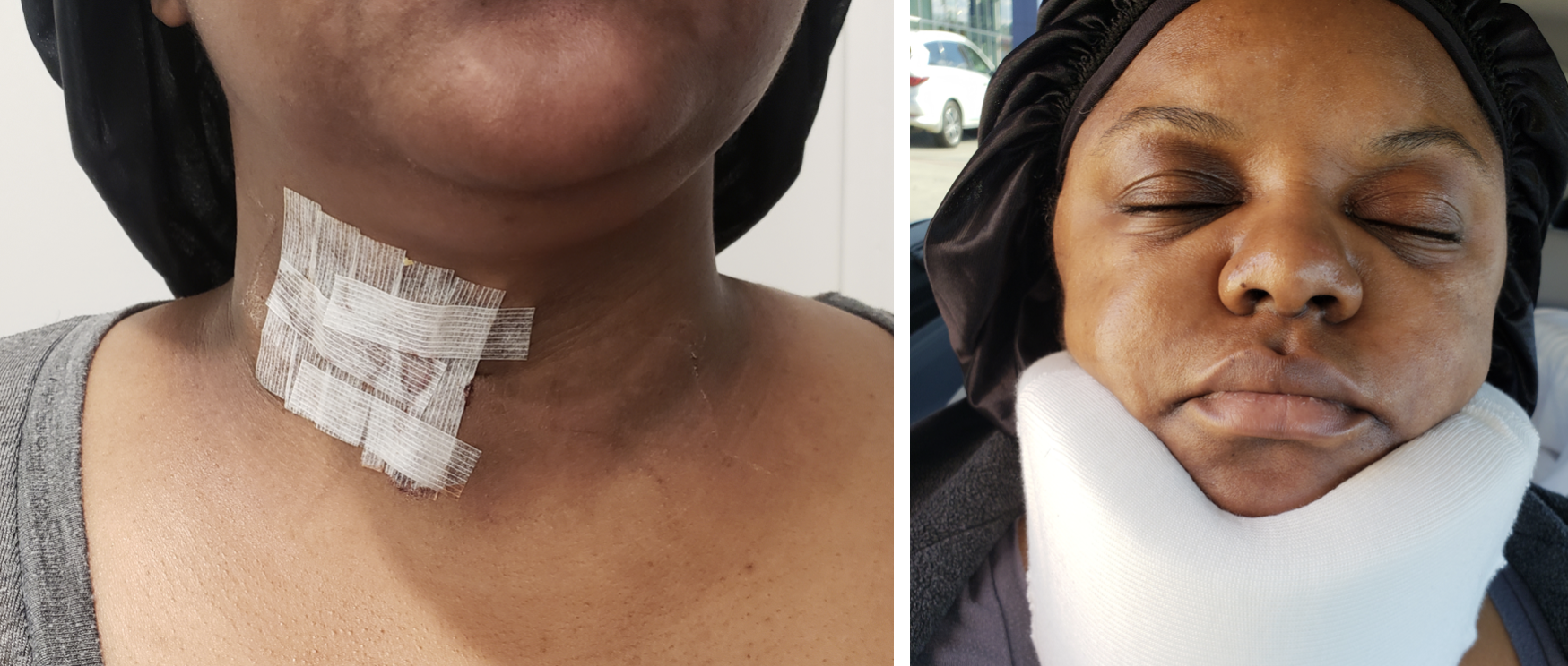 Vanessia Clark blog image 1 - neck surgery